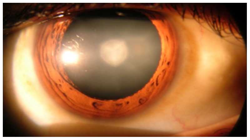 Clear Vision, Clear Decisions: Navigating Modern Laser Eye Surgery Options